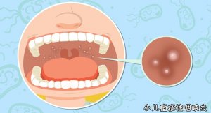 疱疹性咽峡炎四个时期表现症状