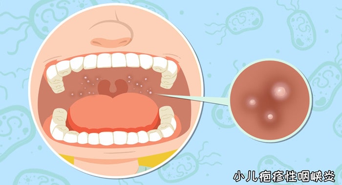 疱疹性咽峡炎四个时期表现症状