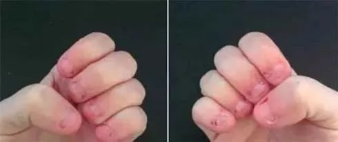 婴儿吃手要不要强行制止？