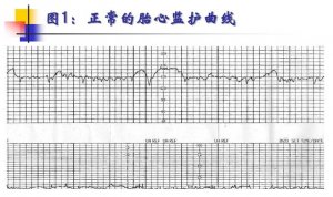 胎心监护图怎么看 能看男女吗