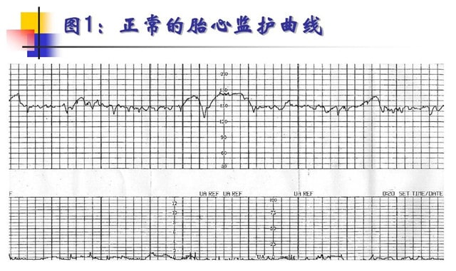 胎心监护图怎么看 能看男女吗