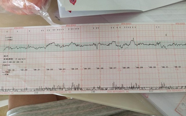 胎心监护图怎么看 能看男女吗