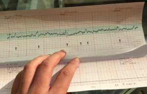 胎心监护图看男女准吗