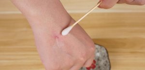 蚊子咬了怎么消肿止痒最快