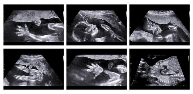 从胎动看男孩女孩准吗