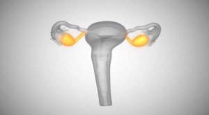 输卵管积水影响试管婴儿的成功率吗？