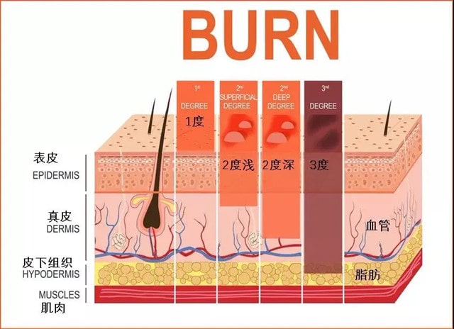 宝宝烫伤后如何处理