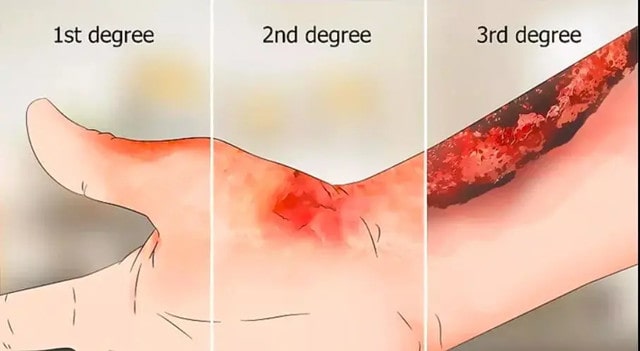 宝宝烫伤后如何处理