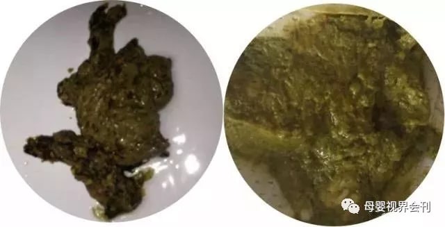 宝宝拉绿色大便怎么回事及应对方法