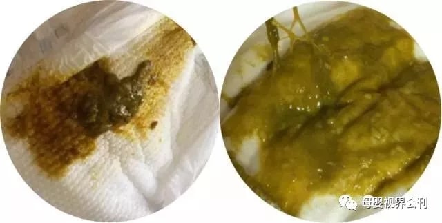 宝宝拉绿色大便怎么回事及应对方法