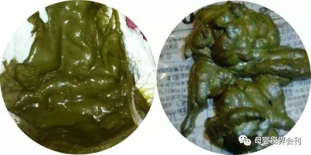 宝宝拉绿色大便怎么回事及应对方法