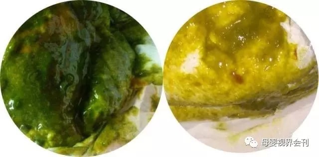 宝宝拉绿色大便怎么回事及应对方法