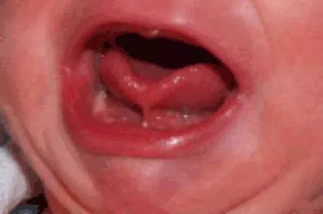 宝宝舌系带过短，一定要手术吗？