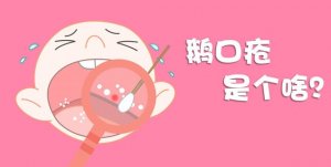 鹅口疮是什么 婴儿鹅口疮症状及治疗