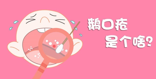 鹅口疮是什么 婴儿鹅口疮症状及治疗
