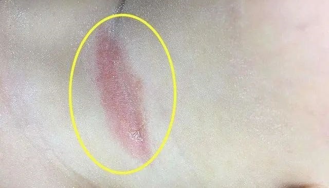 新生儿淹脖子如何护理