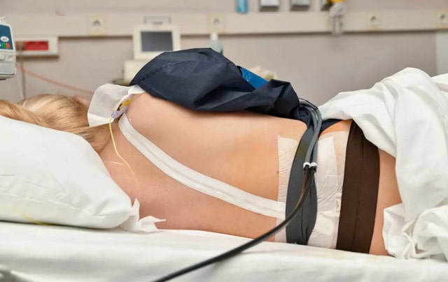 无痛分娩针要不要打