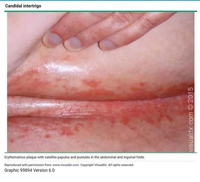 宝宝出汗多，警惕淹脖子