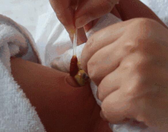 初生婴儿脐带护理很重要，5种异常要注意