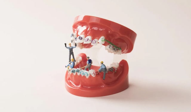 牙齿正畸要不要做 搞清4个问题不纠结