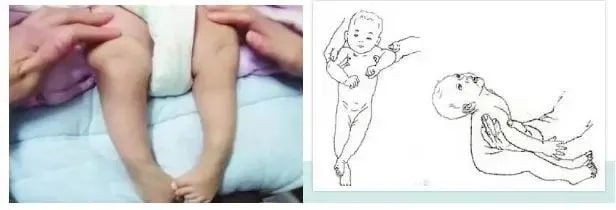 宝宝肌张力高的临床表现有哪些？