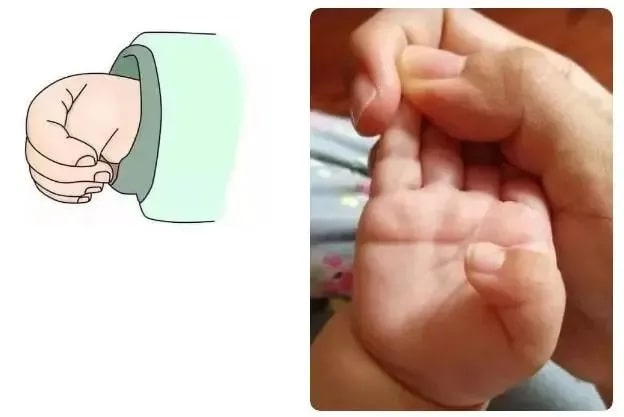 宝宝肌张力高的临床表现有哪些？