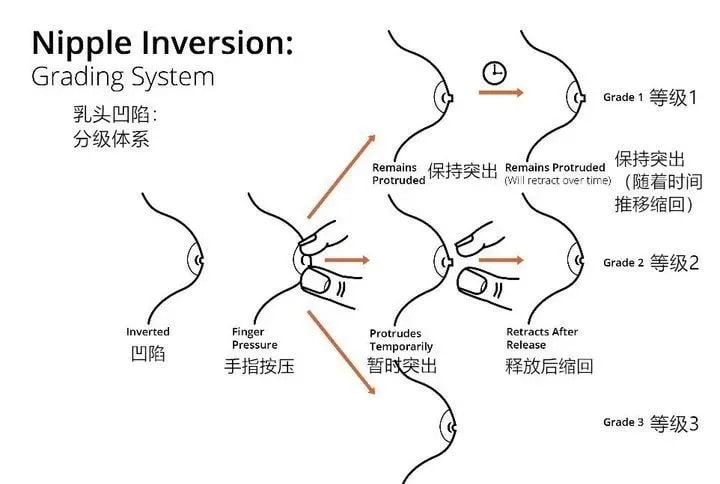 乳头内陷怎么办