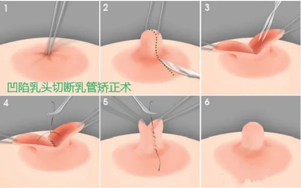 乳头内陷怎么办