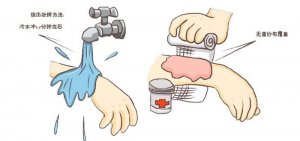 烫伤后如何处理