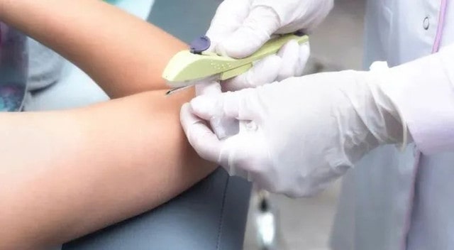 皮下埋植避孕法