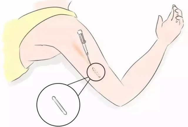 皮下埋植避孕法