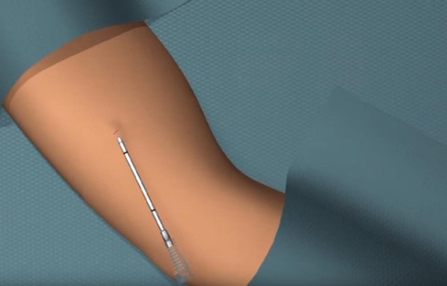 皮下埋植避孕法