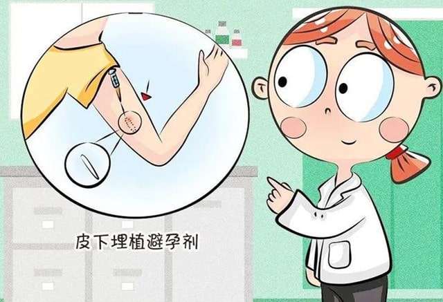 皮下埋植避孕法