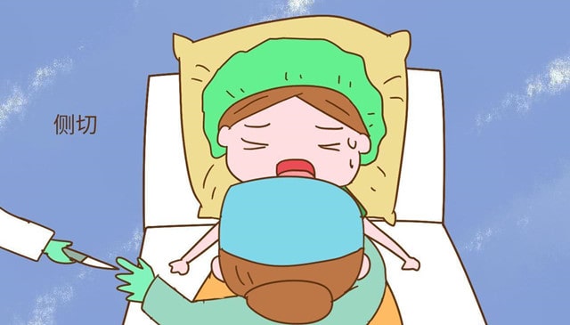 顺产分娩会阴侧切术指征