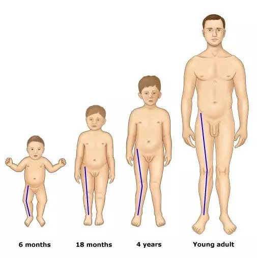 宝宝腿不直怎么办 x型腿怎么矫正