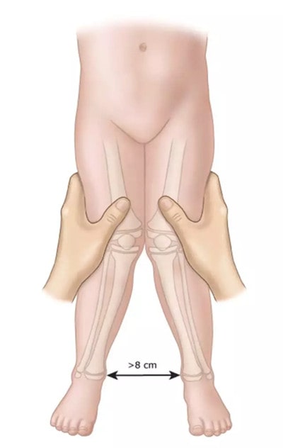 宝宝腿不直怎么办 x型腿怎么矫正