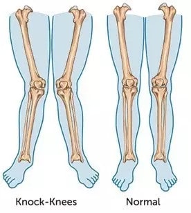 宝宝腿不直怎么办 x型腿怎么矫正