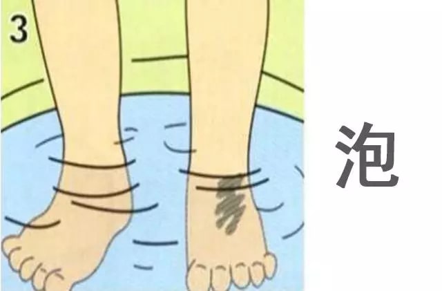 小孩烫伤怎么办，先脱衣服还是先冲水？