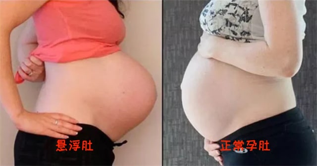 悬浮肚一定要剖腹产吗？