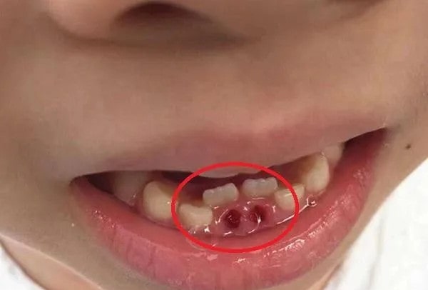 儿童换牙注意事项，需注意这5个方面