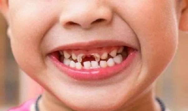 儿童换牙注意事项，需注意这5个方面
