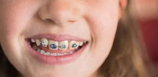 儿童换牙注意事项，需注意这5个方面