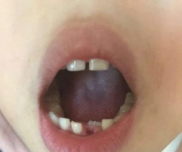 儿童换牙注意事项，需注意这5个方面
