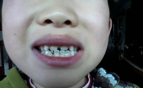 儿童换牙注意事项，需注意这5个方面