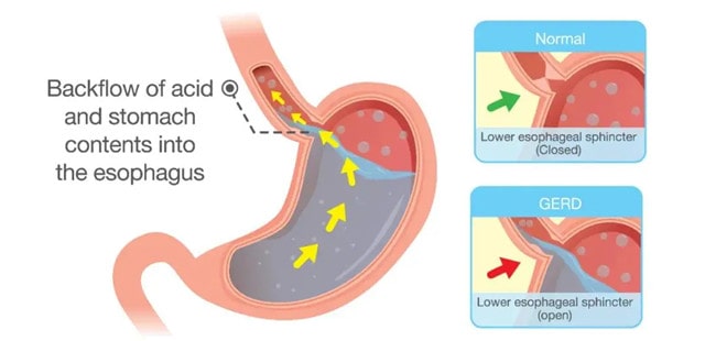 宝宝口臭是什么原因 口臭怎么办