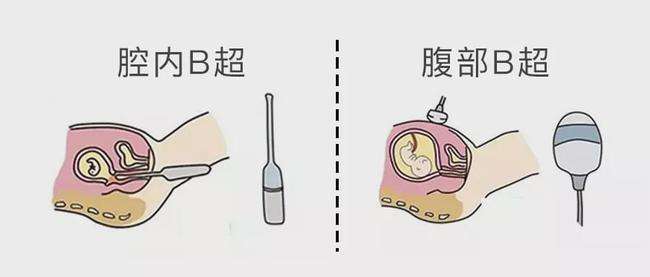 阴超检查和b超的区别