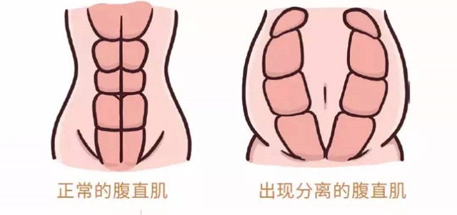产后腹直肌分离，不处理会怎么样？