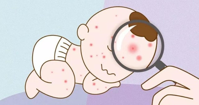 冬季宝宝过敏怎么办