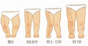 婴儿的腿不直，绑腿会不会好点？