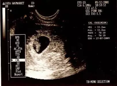 早期孕囊形状看男女